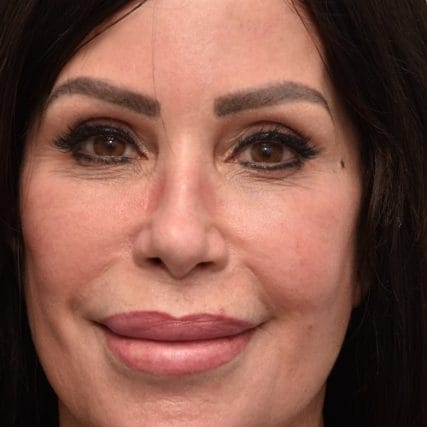 Deep-Plane-Facelift-3