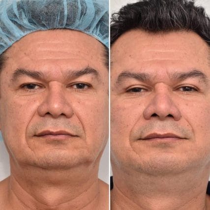 Deep-Plane-Facelift-4