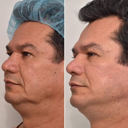 Deep-Plane-Facelift-5