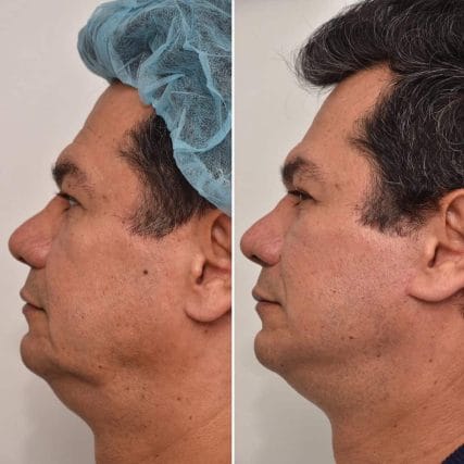 Deep-Plane-Facelift-6