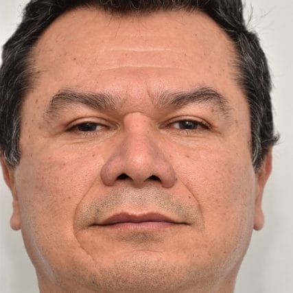 Deep-Plane-Facelift-8