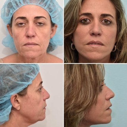 Deep-Plane-Facelift-9