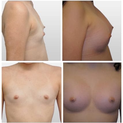 breast-surgery-miami-carlos-spera-1