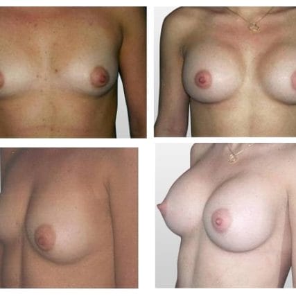 breast-surgery-miami-carlos-spera-10