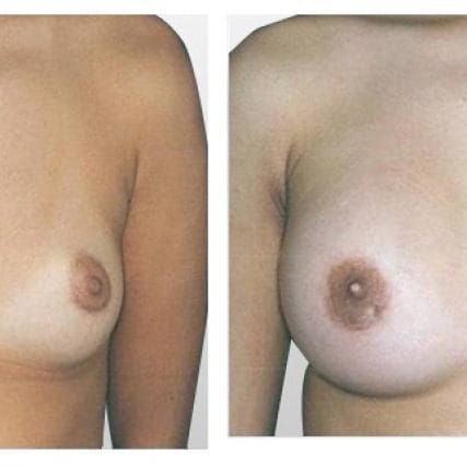 breast-surgery-miami-carlos-spera-11