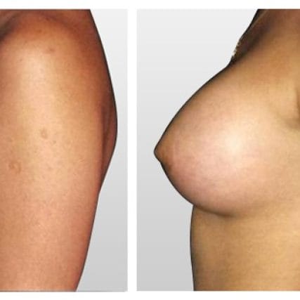 breast-surgery-miami-carlos-spera-12