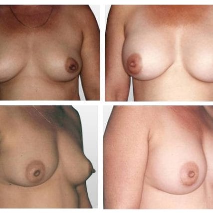 breast-surgery-miami-carlos-spera-13