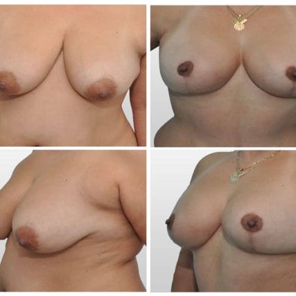 breast-surgery-miami-carlos-spera-15
