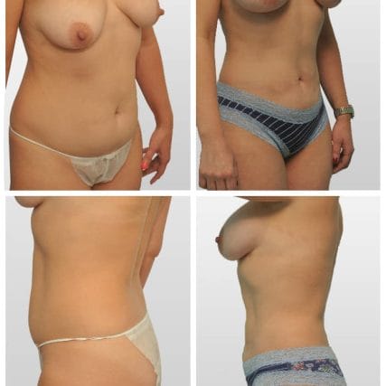 breast-surgery-miami-carlos-spera-16