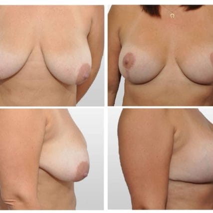 breast-surgery-miami-carlos-spera-17