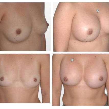 breast-surgery-miami-carlos-spera-18