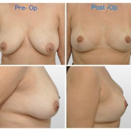 breast-surgery-miami-carlos-spera-2