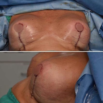 breast-surgery-miami-carlos-spera-22