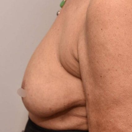 breast-surgery-miami-carlos-spera-26