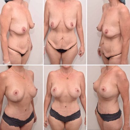breast-surgery-miami-carlos-spera-3