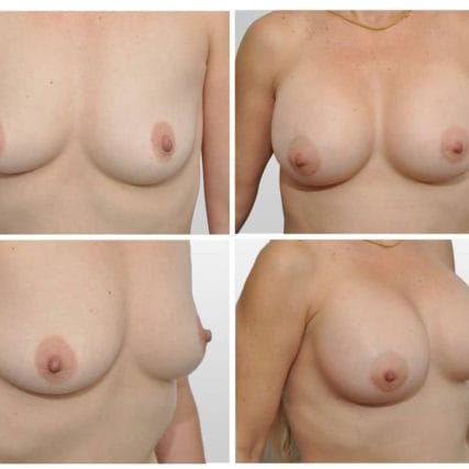 breast-surgery-miami-carlos-spera-4