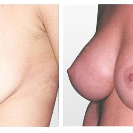 breast-surgery-miami-carlos-spera-5