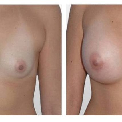 breast-surgery-miami-carlos-spera-6