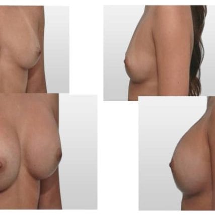 breast-surgery-miami-carlos-spera-7