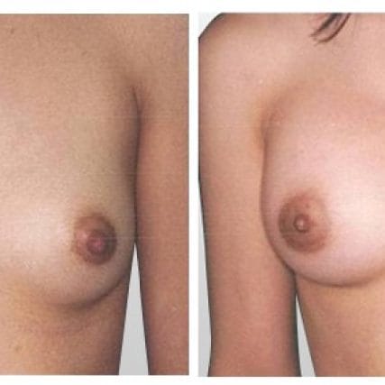 breast-surgery-miami-carlos-spera-8