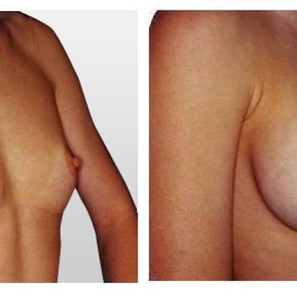 breast-surgery-miami-carlos-spera-9