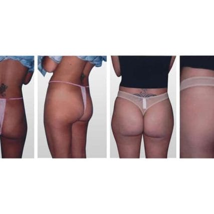 butt-lift-gluteoplasty-miami-carlos-spera-10