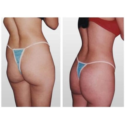 butt-lift-gluteoplasty-miami-carlos-spera-11