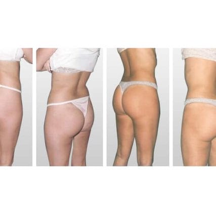 butt-lift-gluteoplasty-miami-carlos-spera-12