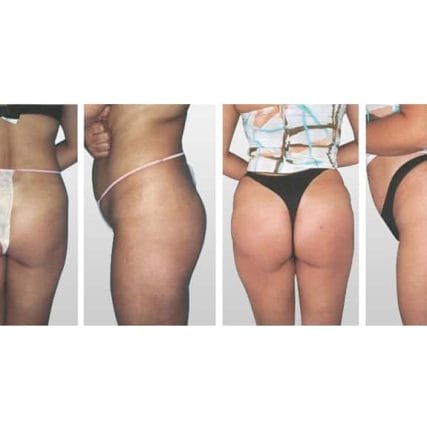 butt-lift-gluteoplasty-miami-carlos-spera-13