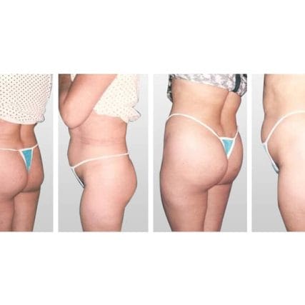 butt-lift-gluteoplasty-miami-carlos-spera-14