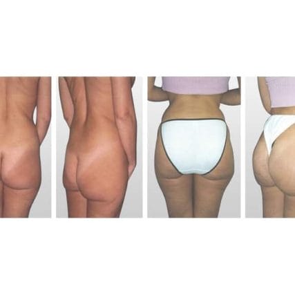 butt-lift-gluteoplasty-miami-carlos-spera-15