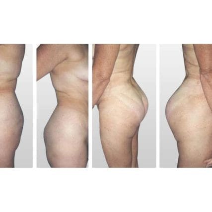 butt-lift-gluteoplasty-miami-carlos-spera-16