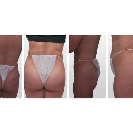 butt-lift-gluteoplasty-miami-carlos-spera-18