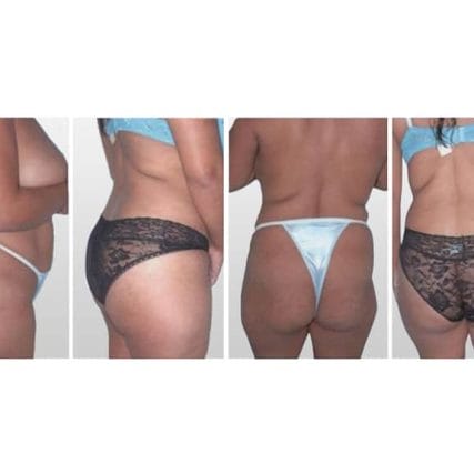 butt-lift-gluteoplasty-miami-carlos-spera-3