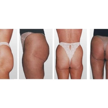 butt-lift-gluteoplasty-miami-carlos-spera-6