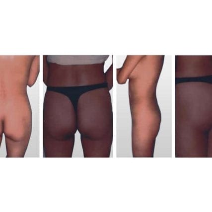 butt-lift-gluteoplasty-miami-carlos-spera-7