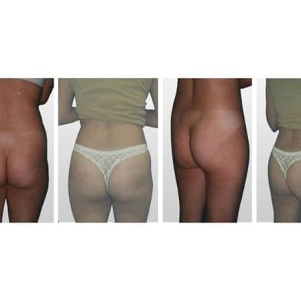 butt-lift-gluteoplasty-miami-carlos-spera-9