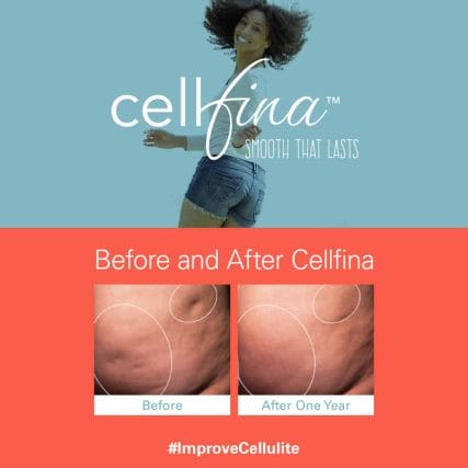 cellfina-cellulite-treatment-miami-carlos-spera-1