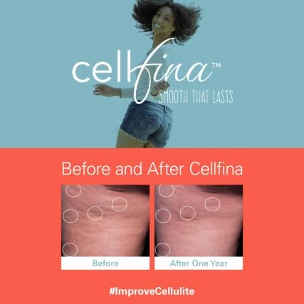 cellfina-cellulite-treatment-miami-carlos-spera-10