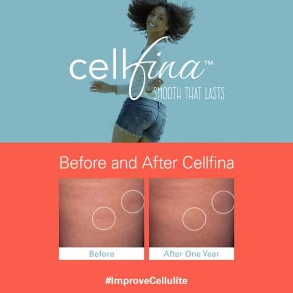 cellfina-cellulite-treatment-miami-carlos-spera-11