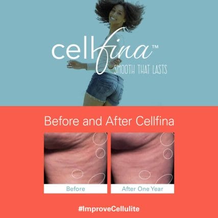 cellfina-cellulite-treatment-miami-carlos-spera-12