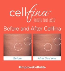 cellfina-cellulite-treatment-miami-carlos-spera-13