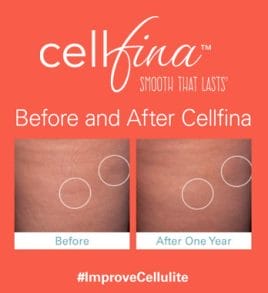 cellfina-cellulite-treatment-miami-carlos-spera-13