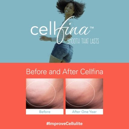 cellfina-cellulite-treatment-miami-carlos-spera-2