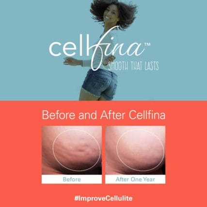 cellfina-cellulite-treatment-miami-carlos-spera-3