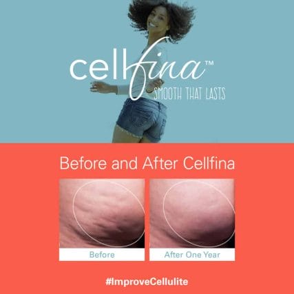 cellfina-cellulite-treatment-miami-carlos-spera-4