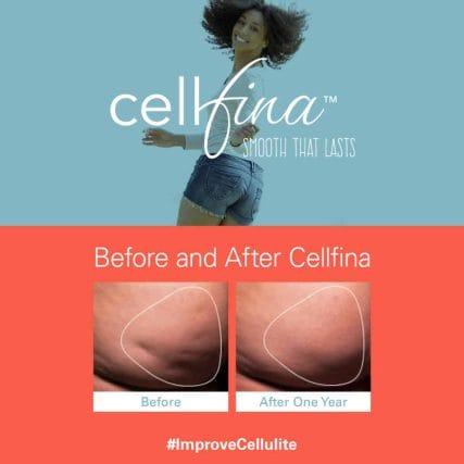 cellfina-cellulite-treatment-miami-carlos-spera-5