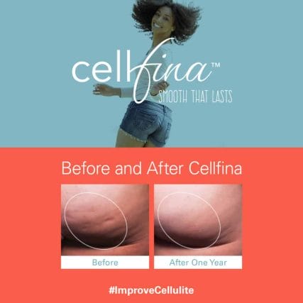 cellfina-cellulite-treatment-miami-carlos-spera-6
