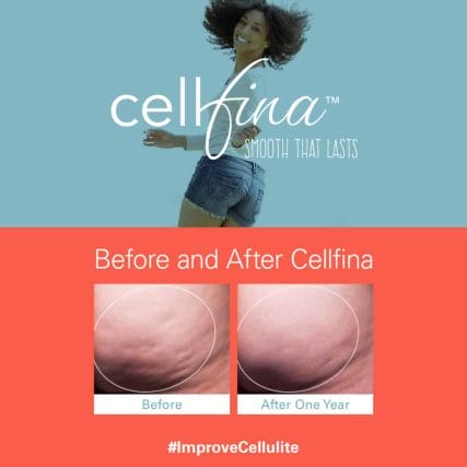 cellfina-cellulite-treatment-miami-carlos-spera-7