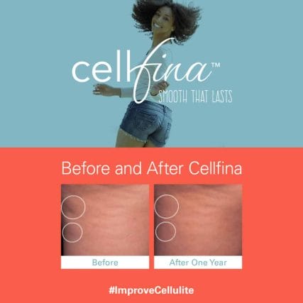 cellfina-cellulite-treatment-miami-carlos-spera-8